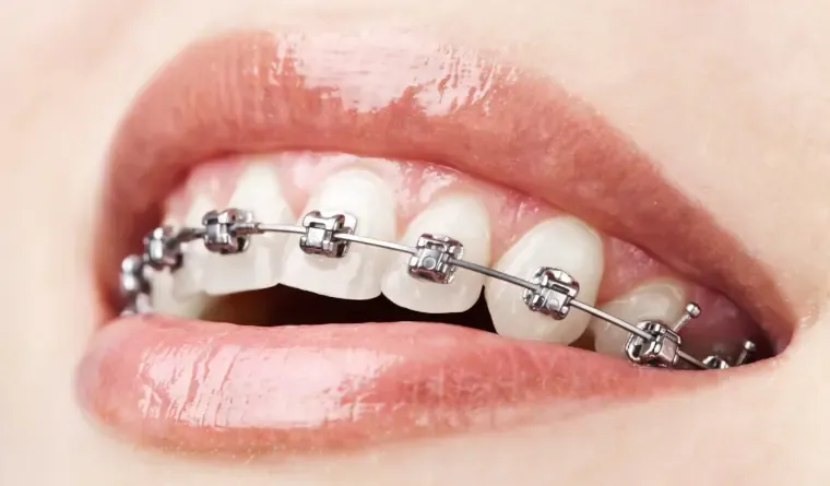 Brackets Autoligables en Concepción