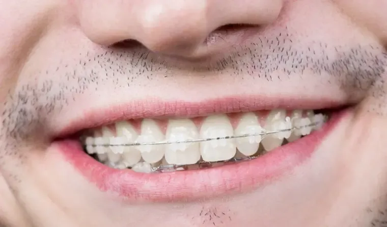 Brackets Cerámicos en Concepción