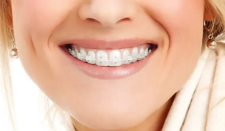 Brackets Estéticos de Zafiro en Concepción