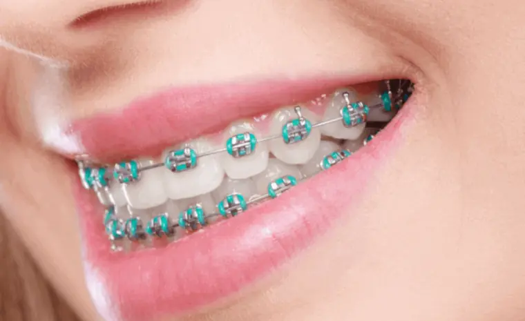 Brackets Metálicos Tradicionales