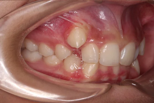Apiñamiento Dental Antes de Ortodoncia